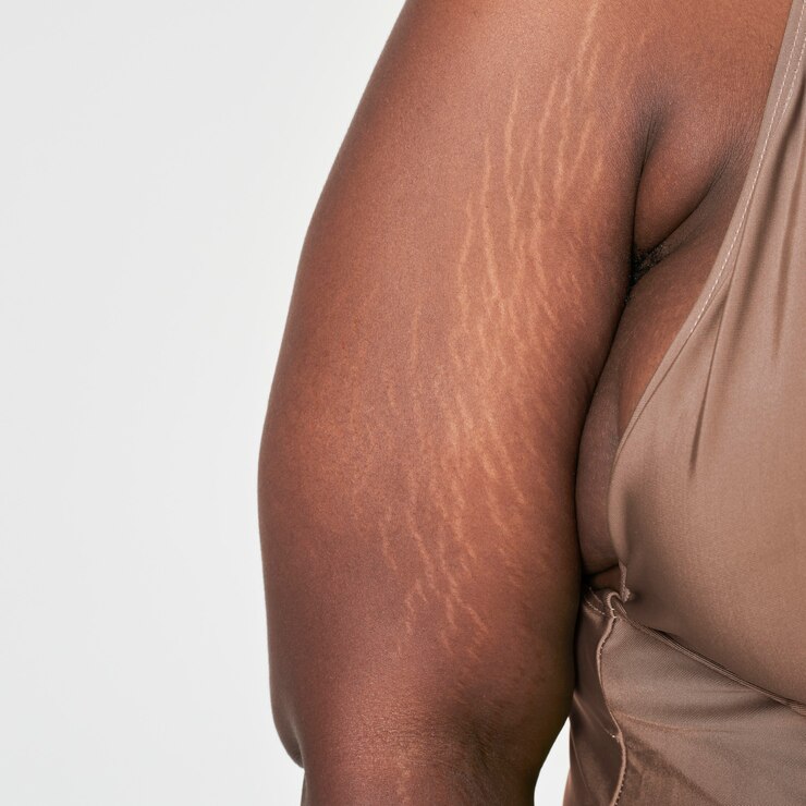 stretch marks